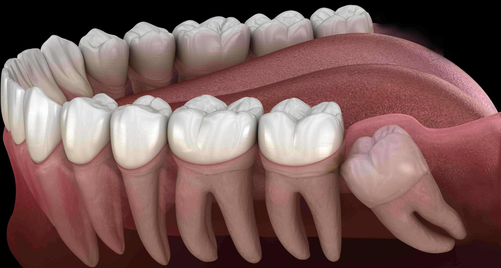 Wisdom Tooth Removal: Signs, Procedure, and Recovery Guide