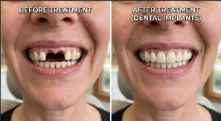 Dental Implants in Dubai: Everything You Need to Know Before You Decide
