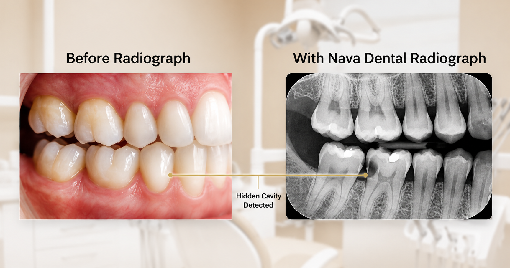 Dental radiograph showing a hidden cavity detected during a dental checkup